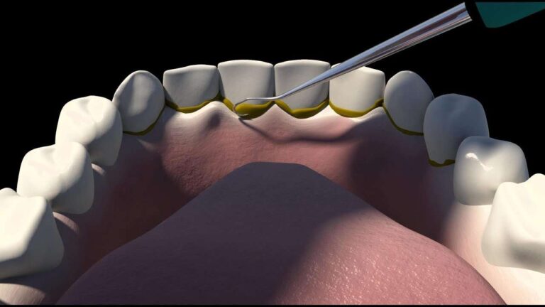 Everything You Want to Know About Dental Scaling