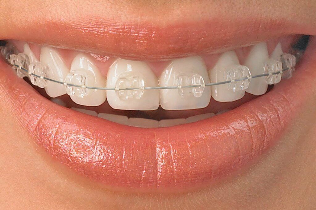 Ceramic Braces – Less Noticeable 1 Ceramic braces