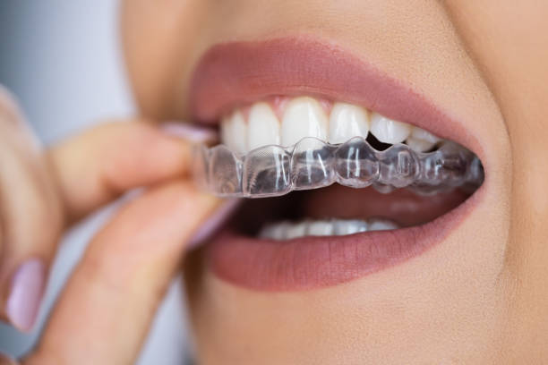 Clear aligners