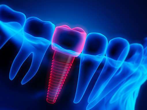 Midline Diastema 