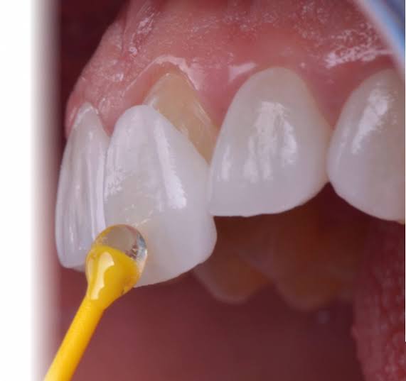 Dental Veneers & Bonding – Instantly Perfect Teeth! 1 Veneers