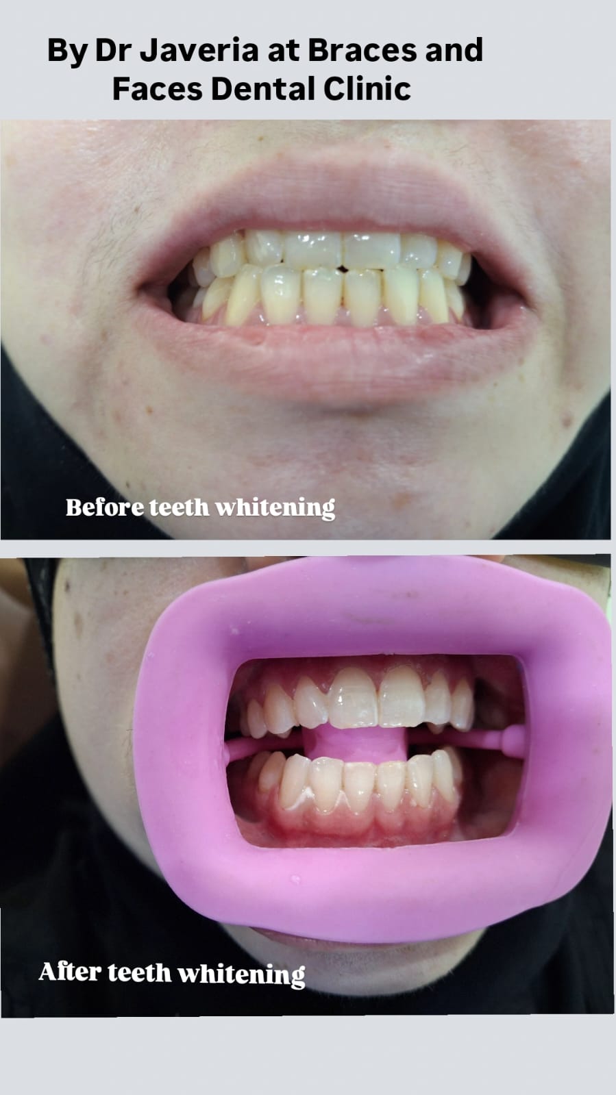 Teeth Whitening (Bleaching) – Instantly Brighter Teeth! 2 teeth whitening