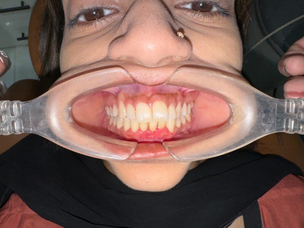 Metal Braces before 1 scaled e1763497621658