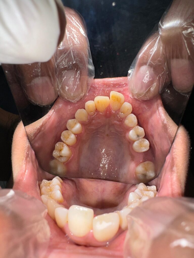 Metal Braces before 2 scaled e1763497895782