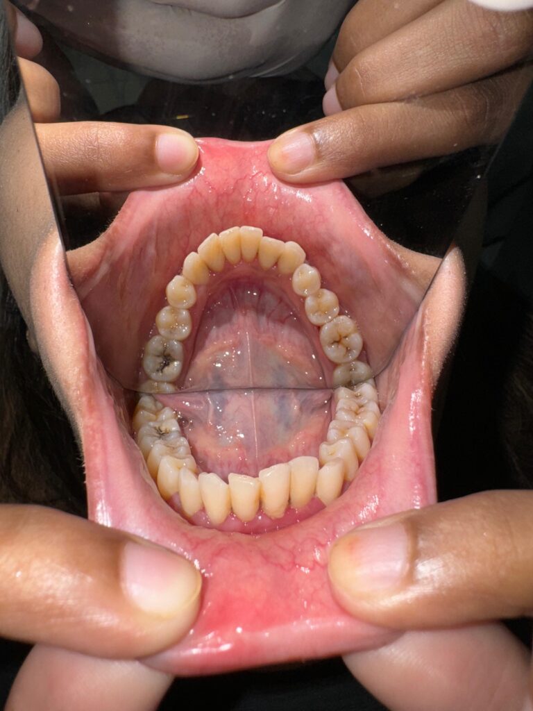 Metal Braces before 3