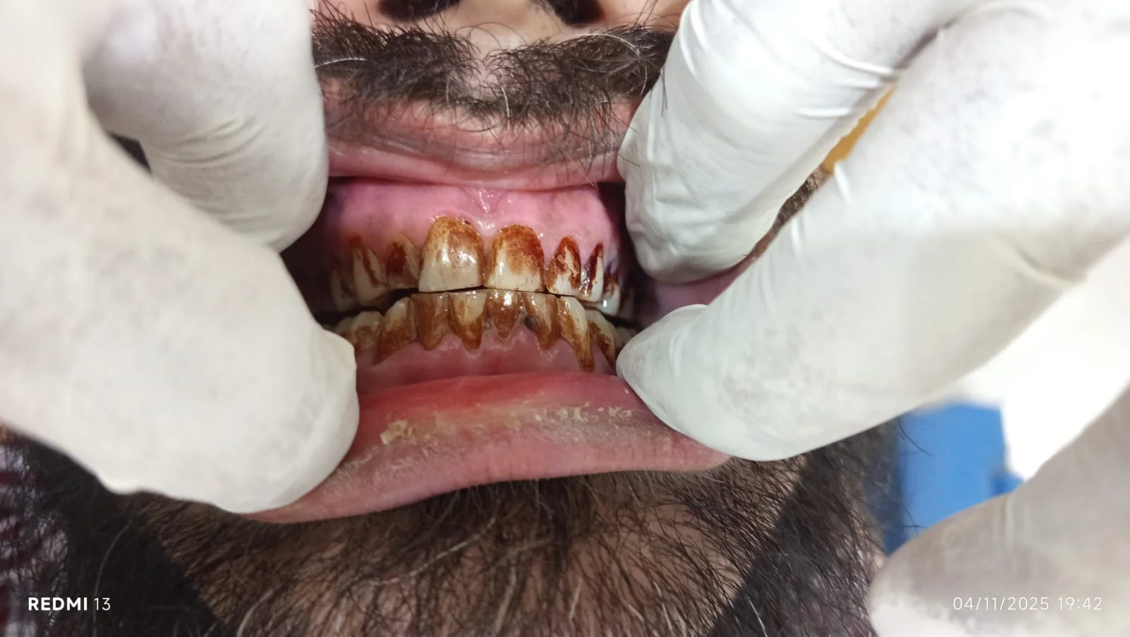 after Whitening Teeth