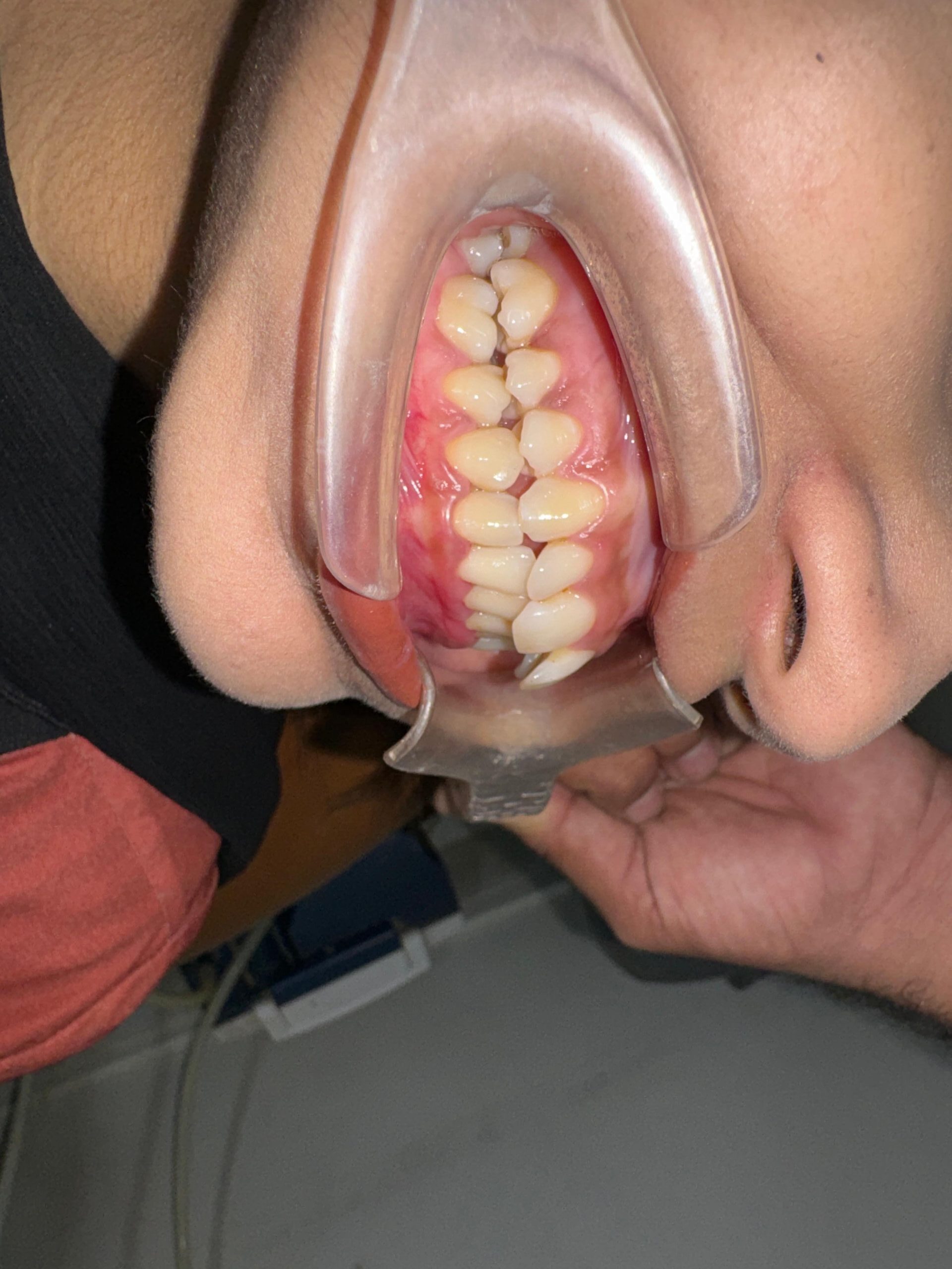 metal braces before 02 scaled e1763498411341