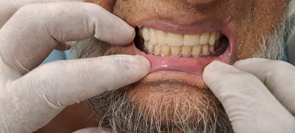 Prosthodontic Denture 1 patient reviews 1